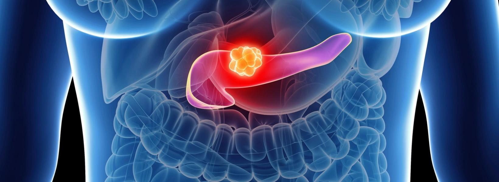 Pankreas Kanseri Kilo Verdirir mi