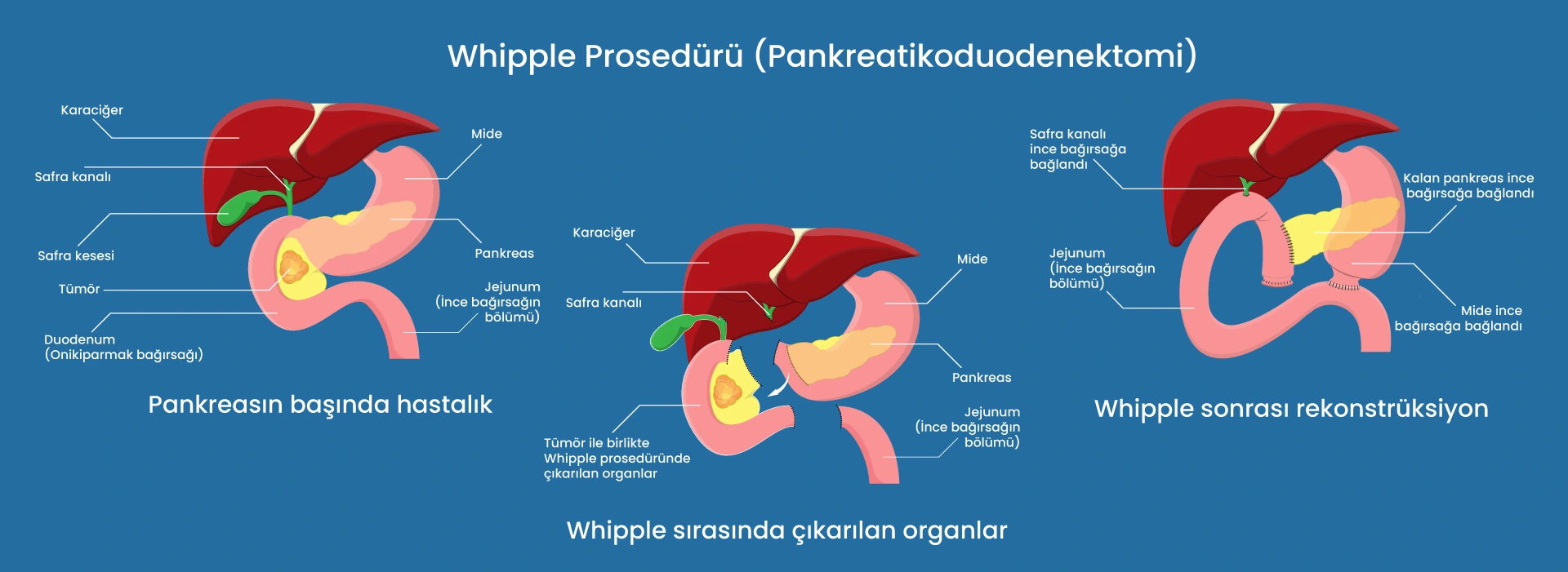 Whipple Ameliyatı Nedir? Nasıl Yapılır, Sonrası Süreç
