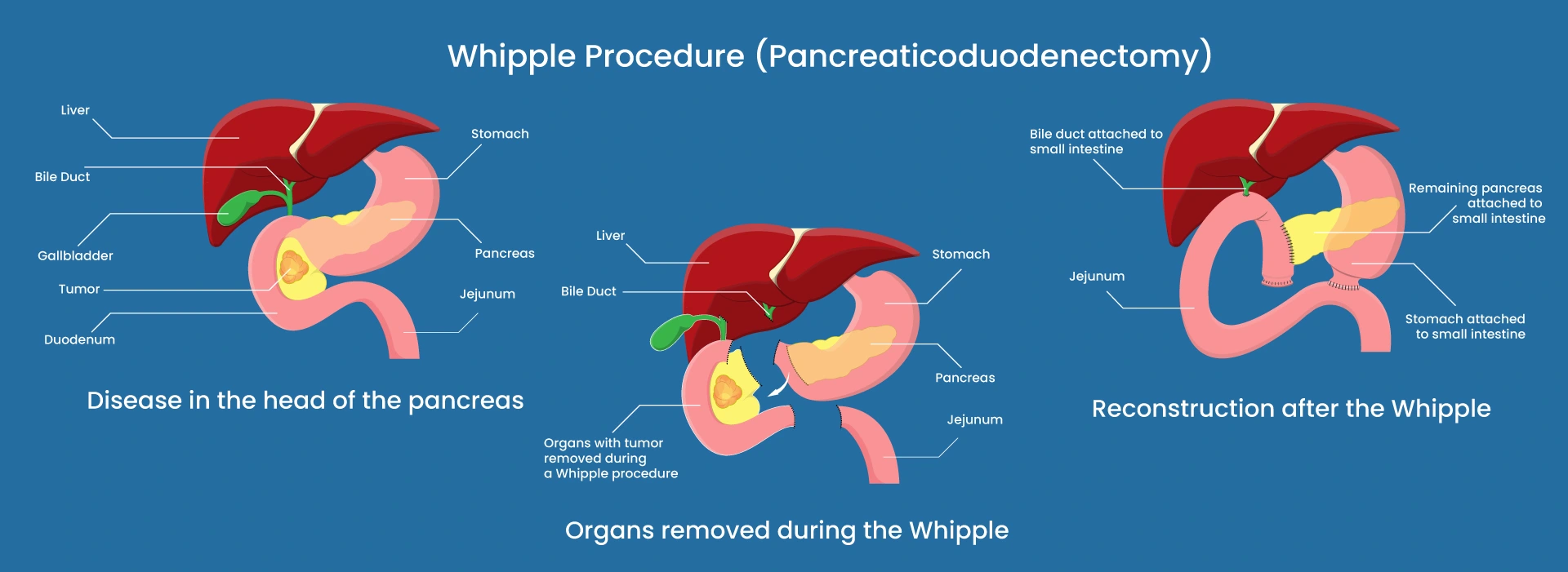 Whipple Surgery in Izmir, Turkey