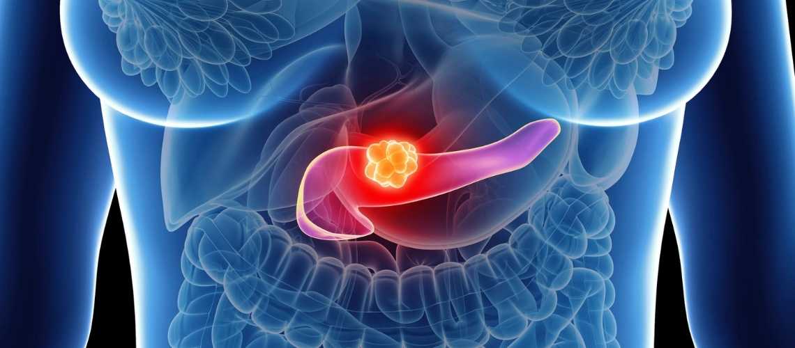 Her Pankreas Kisti Kanser midir ?
