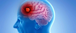 Leverkanker Hersenmetastase Karaciğer Kanseri Beyin Metastazı