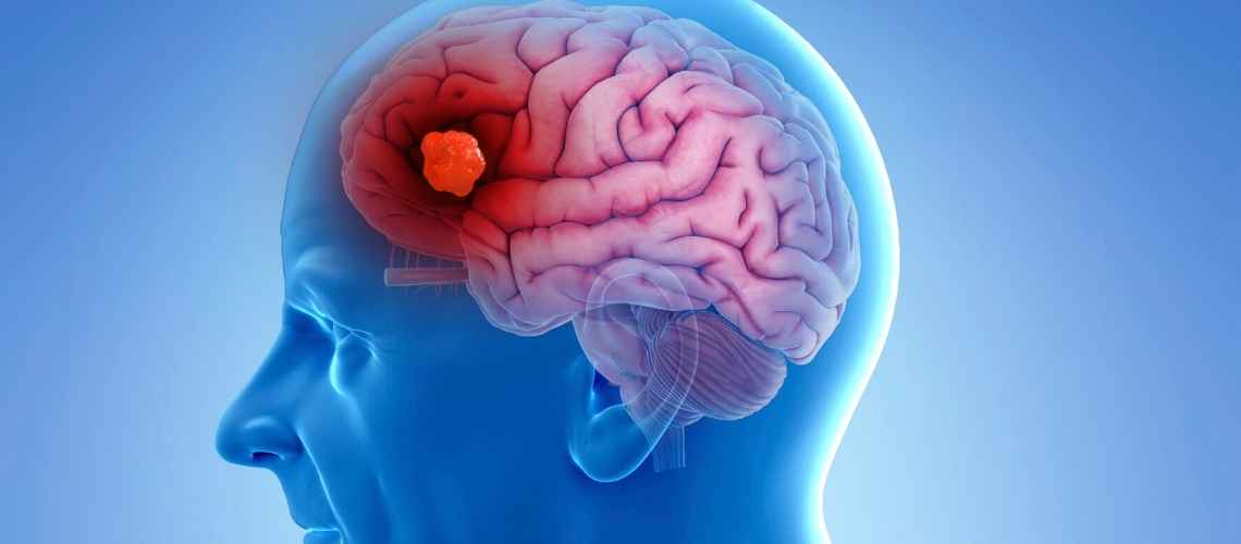 Leverkanker Hersenmetastase Karaciğer Kanseri Beyin Metastazı