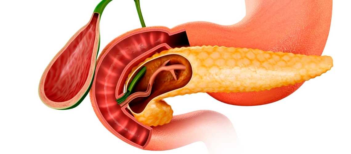 Ductaal adenocarcinoom van de alvleesklier Pankreas Duktal Adenokarsinomu