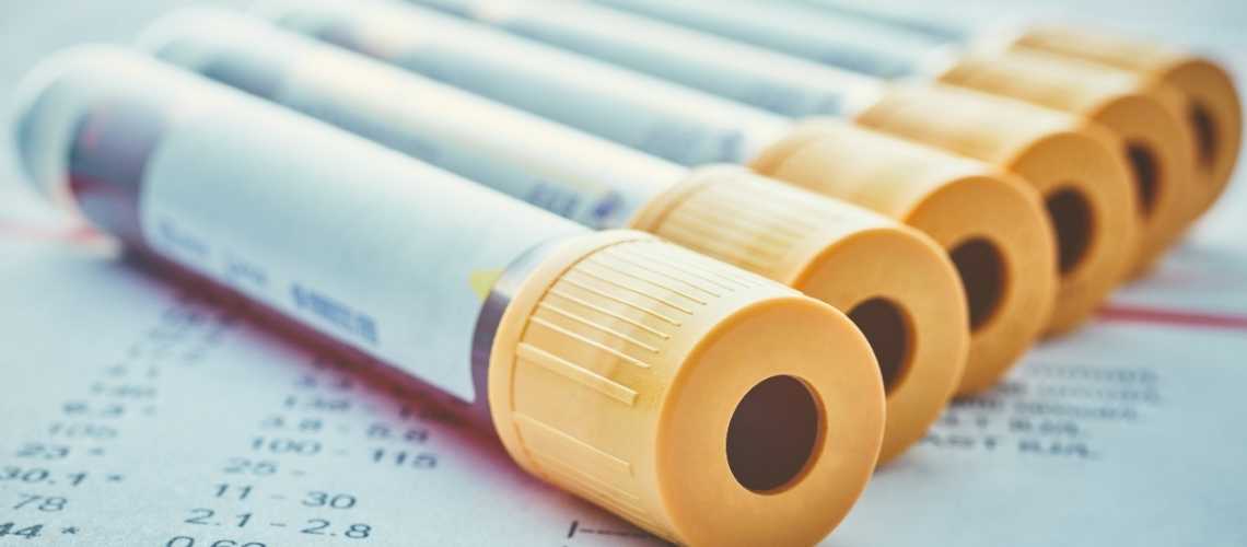 Pankreas Kanseri Hangi Tahlille Belli Olur