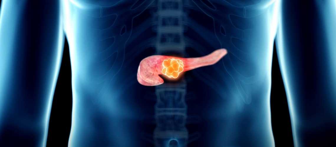 Pankreas Kanseri Nereye Metastaz Yapar