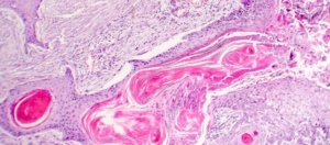 Pancreas acinair celcarcinoom Pankreatik asiner hücreli karsinom