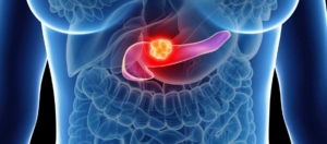 Wat zijn de symptomen van alvleesklierkanker? Pankreas Kanserinin Belirtileri Nelerdir?