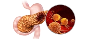 Zijn alle tumoren in de pancreas kwaadaardig? Pankreasta Görülen Bütün Tümörler Kötü Huylu Mudur?