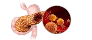 Pankreas Kanseri Neden Bu Kadar Ölümcül?