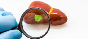 Safra Kesesi İltihabı (Kolesistit) Nedir? Belirtileri Nelerdir?