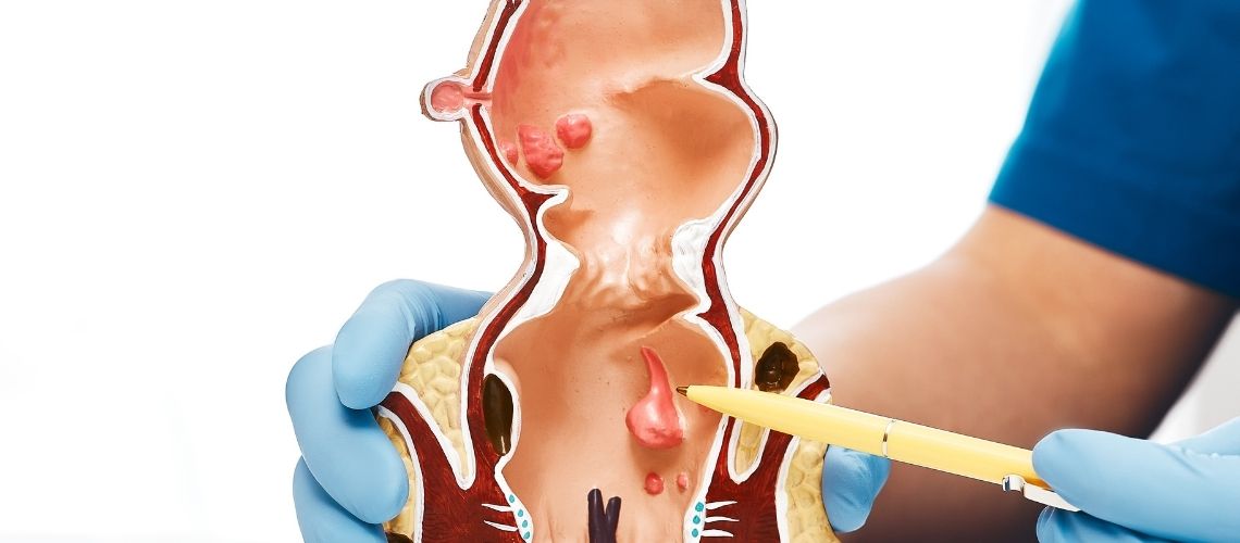 Wie krijgt rectumkanker en hoe wordt het behandeld? Wie krijgt rectumkanker en hoe wordt het behandeld?