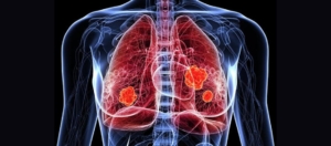 Pancreaskanker Longmetastasen Pankreas Kanseri Akciğer Metastazı