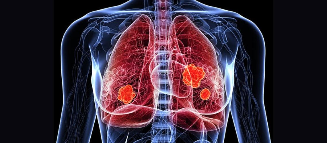Pankreas Kanseri Akciğer Metastazı Pankreas Kanseri Akciğer Metastazı