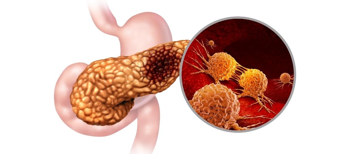 Pankreas Kanserinin Tamamen İyileşme Umudu Var Mı