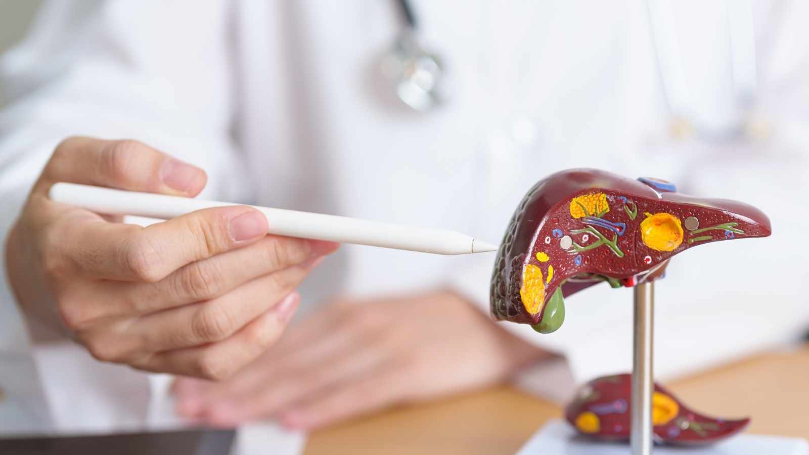 Leverhemangioom Leverhemangioom