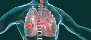 Longkanker Levermetastasen Levensverwachting Longkanker Levermetastasen Levensverwachting