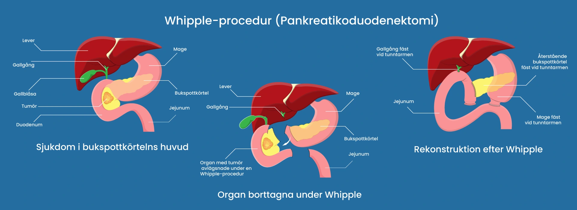Whipple-operation i Izmir, Turkiet