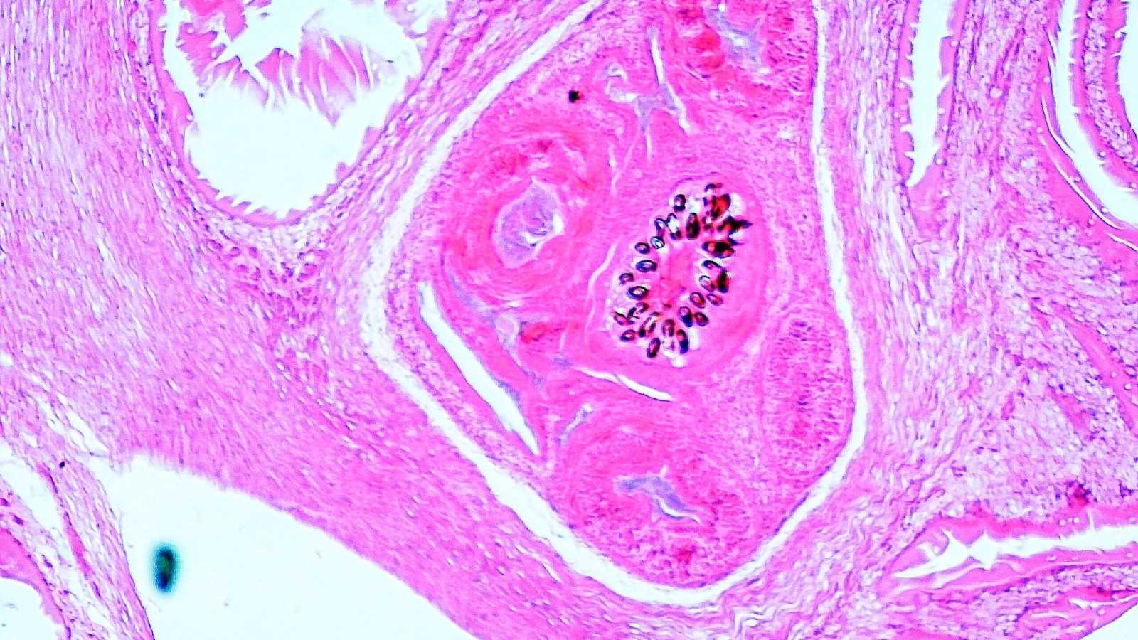 Leberzyste Leberzyste