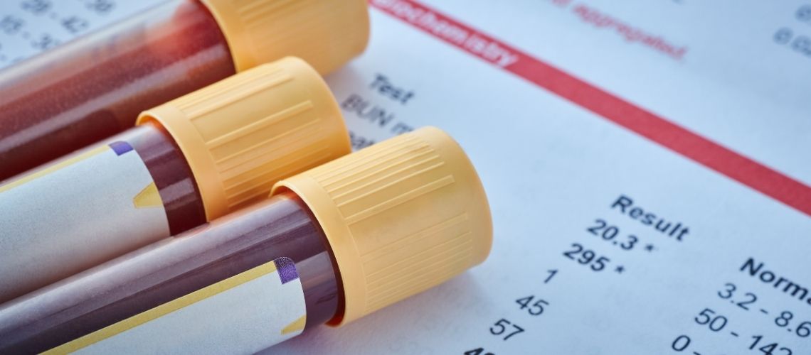 GGT Testi Nedir? Yüksekliği Ve Düşüklüğü Ne Anlama Gelir?