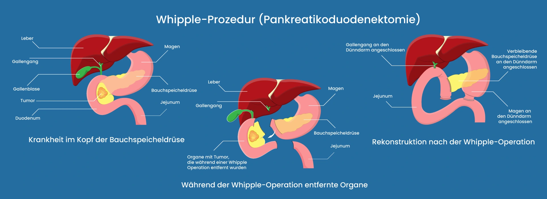Whipple-Operation in Izmir, Türkei Whipple-Operation in Izmir, Türkei