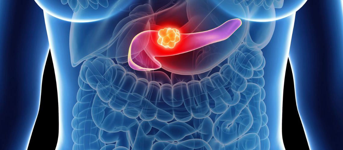 Pankreas Psödokisti Nedir? Belirtileri, Nedenleri ve Ameliyatı