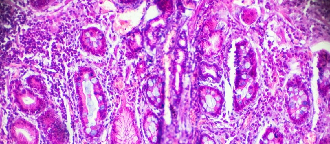 Wat is adenocarcinoom? Hoe wordt het behandeld? Wat is adenocarcinoom? Hoe wordt het behandeld?