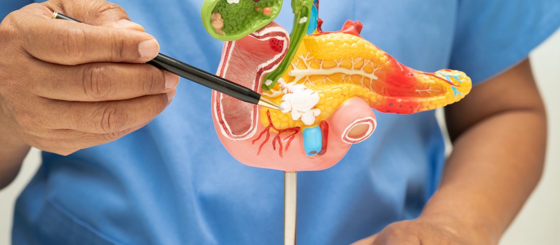 Exocriene pancreasinsufficiëntie (EPI) Exocriene pancreasinsufficiëntie (EPI)