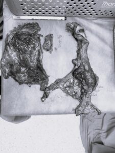 HİPEC (sıcak kemoterapi)