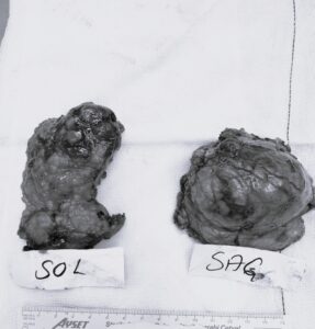 Kitle sebebi ile Bilateral Adrenelektomi