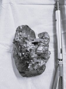 Laparoskopik Distal Pankeotektomi