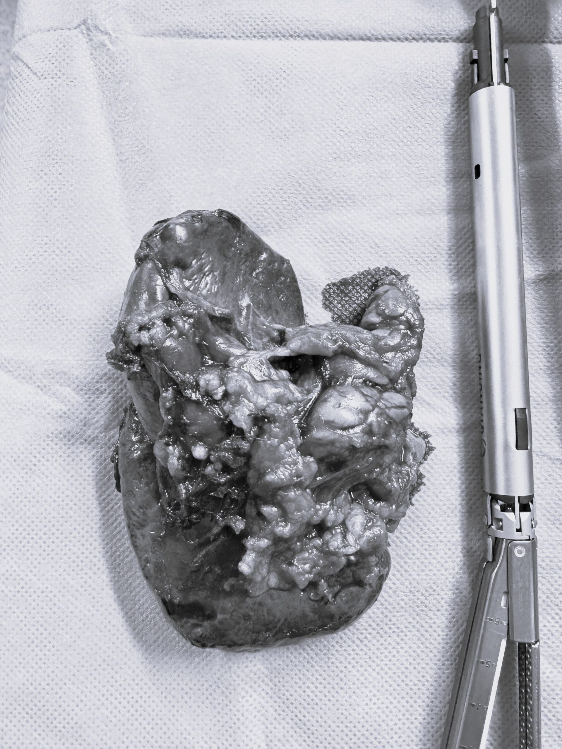 Laparoskopik Distal Pankeotektomi Laparoskopik Distal Pankeotektomi