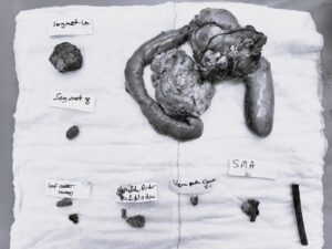 Pankreas Baş kısmında ki yaklaşık 4cm'lik kitlenin Whipple Ameliyatı