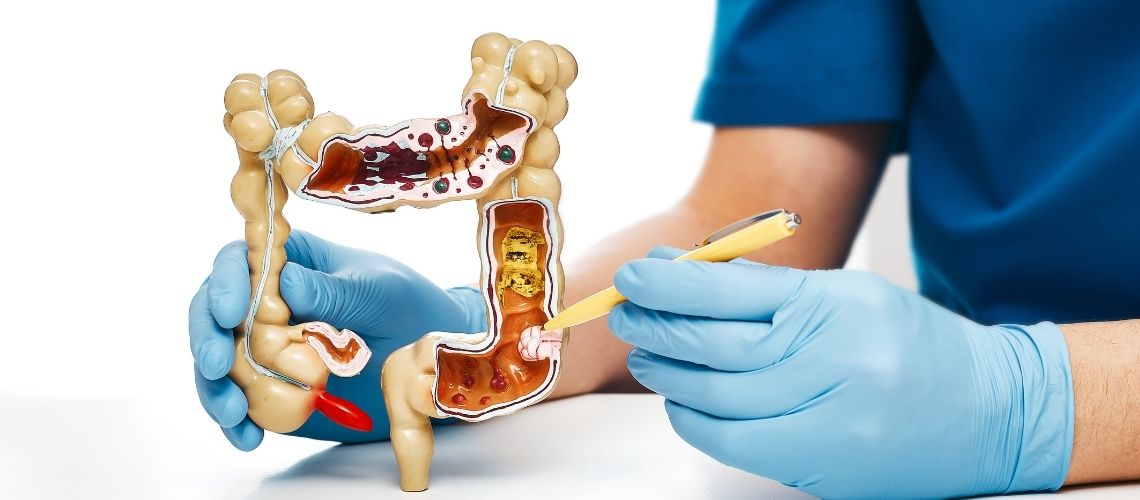 4. Evre kolon kanseri yaşam beklentisi ve sağ kalma oranları