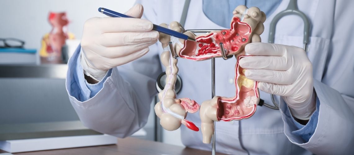 Kolon Kanserinde Tarama ve Testler