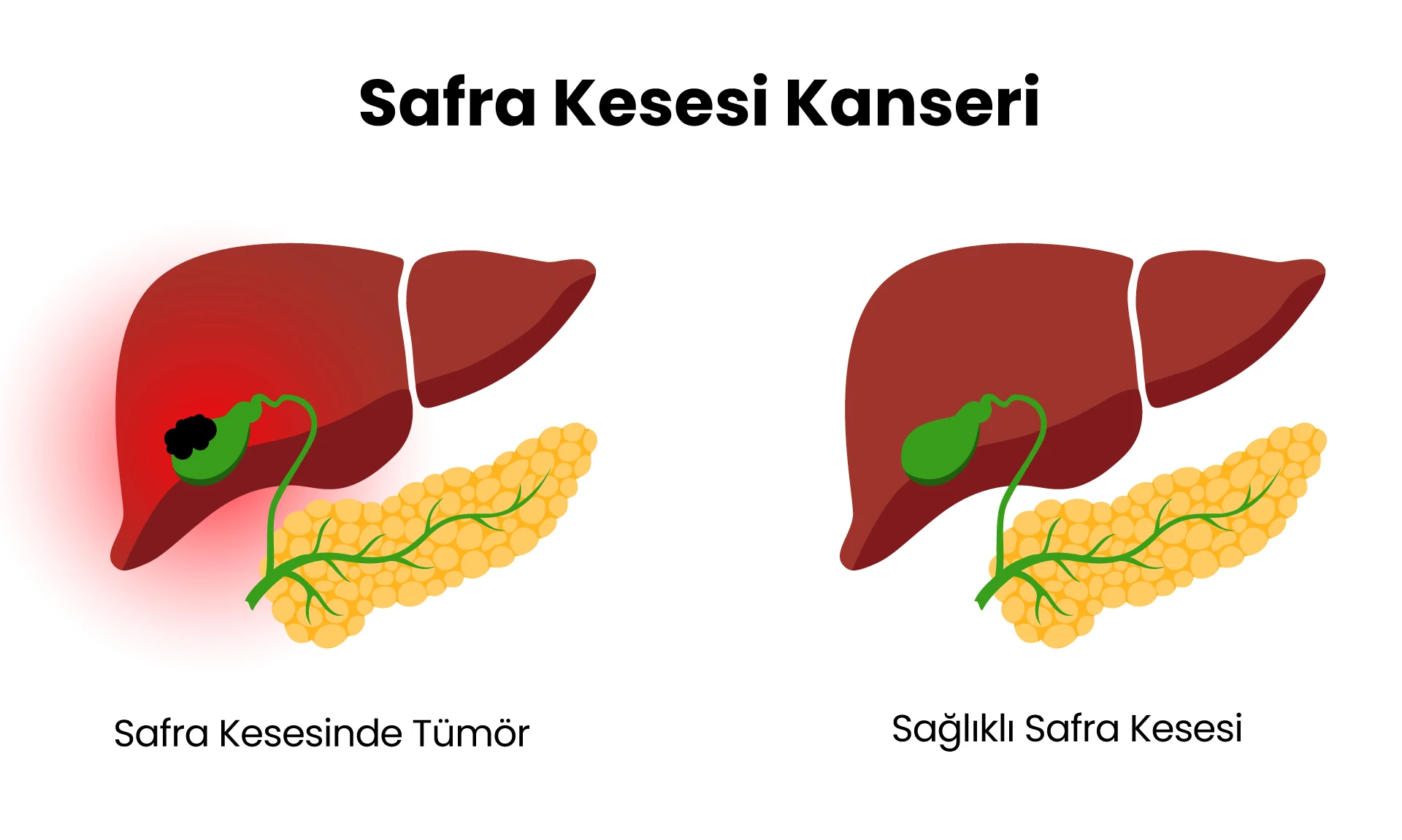 Safra Kesesi Kanseri Nedenler, Belirtileri ve Tedavisi Safra kesesi anatomisi ve kanseri