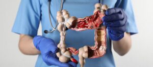 Kolon Kanseri 1. Evre Belirtileri ve Teşhisi Kolon Kanseri 1. Evre Belirtileri ve Teşhisi