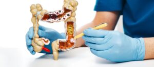 Kolon Kanseri 4. Evre Belirtileri ve Kurtulma Şansı Kolon Kanseri 4. Evre Belirtileri ve Kurtulma Şansı