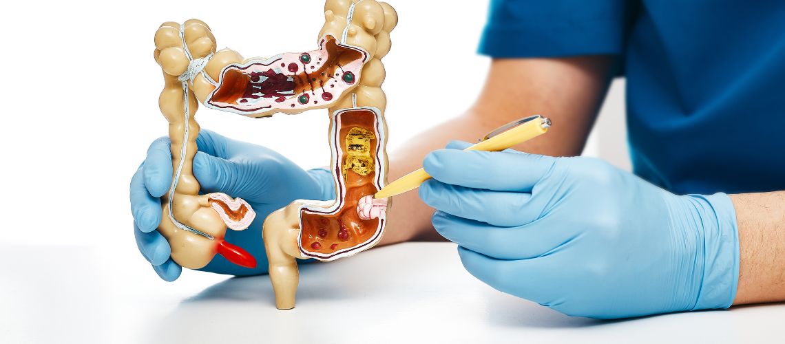 Kolon Kanseri 4. Evre Belirtileri ve Kurtulma Şansı