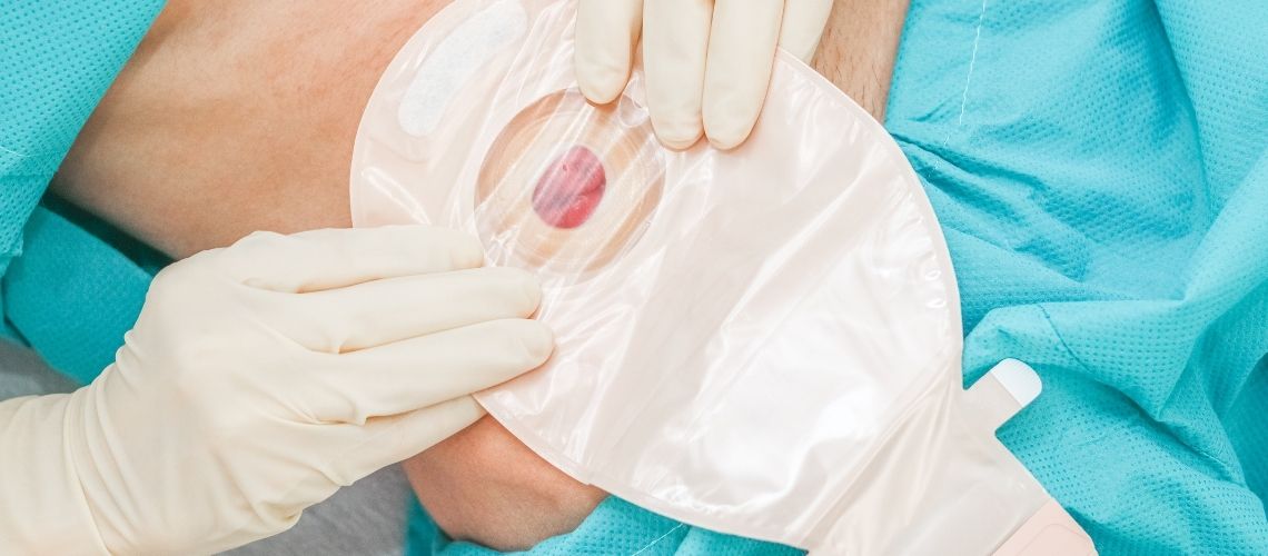 Kolostomi Torbası Nedir? Neden Takılır, Nasıl Boşaltılır?