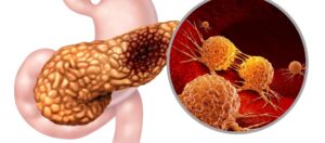 Oligometastatik pankreas kanserinde cerrahi: Biyolojik rezektabilitenin tanımlanması Oligometastatik pankreas kanserinde cerrahi: Biyolojik rezektabilitenin tanımlanması