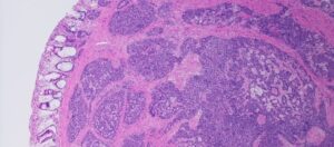 Neoplazma Nedir? Neoplazma Nasıl Ortaya Çıkarılır? Neoplazma Nedir? Neoplazma Nasıl Ortaya Çıkarılır?