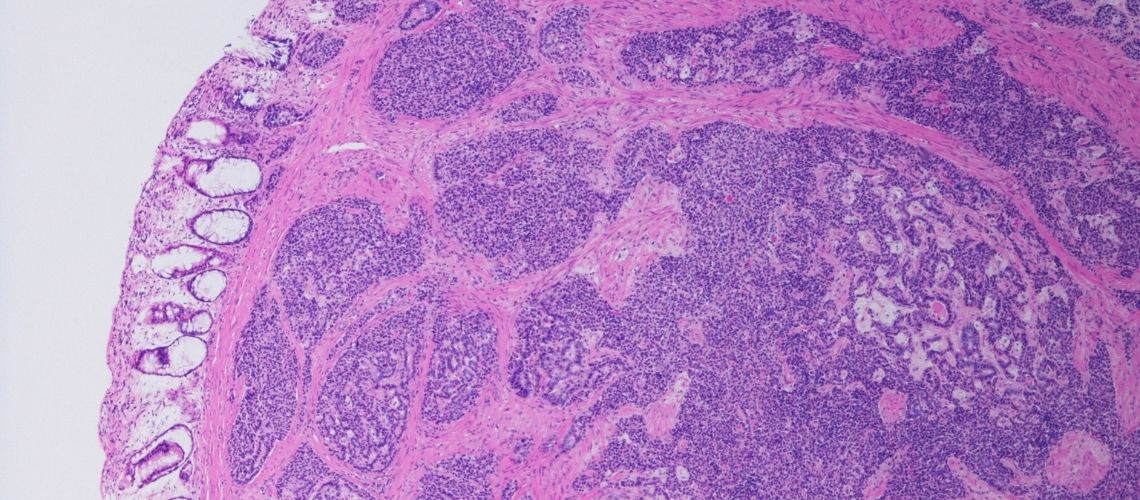 Neoplazma Nedir? Neoplazma Nasıl Ortaya Çıkarılır?